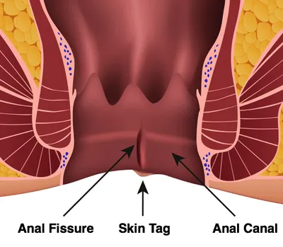 Anal Fissures Uncovered: Causes, Symptoms, and How to Find Relief - Sharvari Hospital Blog