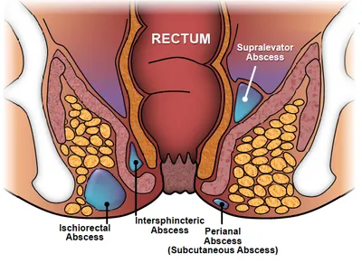 Perianal Abscess in Pune: Treatment, Cost, and Why It Often Becomes a Fistula — featured image, Sharvari Hospital blog