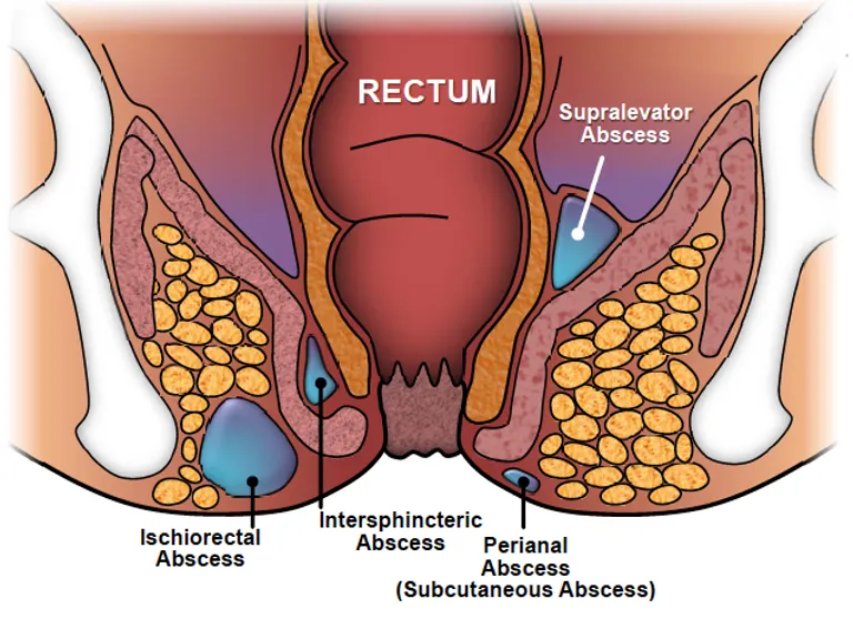 Perianal Abscess in Pune: Treatment, Cost, and Why It Often Becomes a Fistula — hero image, Sharvari Hospital blog
