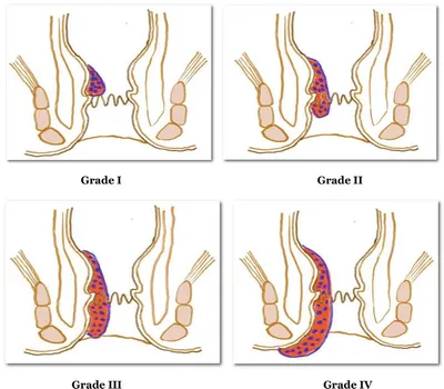 Different Types of Hemorrhoids Surgery. - Sharvari Hospital Blog