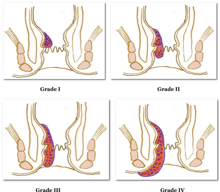 Different Types of Hemorrhoids Surgery. — hero image, Sharvari Hospital blog