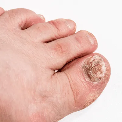 Onychomycosis: A Fungal Infection of the Nails - Sharvari Hospital Blog