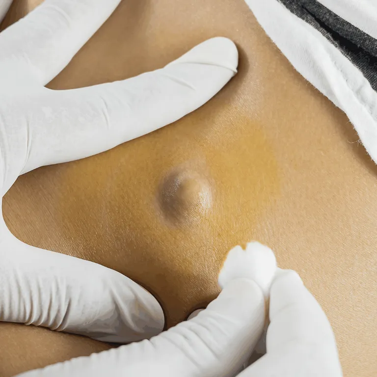Sebaceous Cyst: Causes, Symptoms, and Treatment — hero image, Sharvari Hospital blog