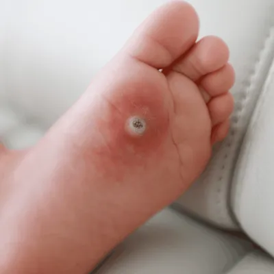 Callosity, Corns & Viral Warts: Causes, Symptoms, Treatment (Pune) - Sharvari Hospital Blog