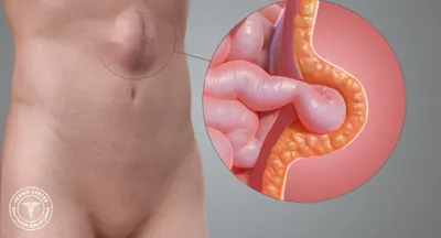 Expert Incisional Hernia Treatment by Hernia Doctor - Sharvari Hospital Blog