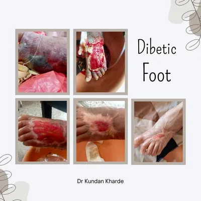 Unveiling the Comprehensive Approach to Chronic Wound Care: A Professional Guide - Sharvari Hospital Blog