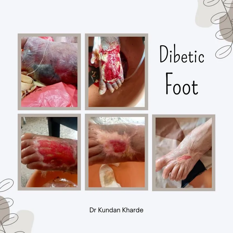 Unveiling the Comprehensive Approach to Chronic Wound Care: A Professional Guide — hero image, Sharvari Hospital blog