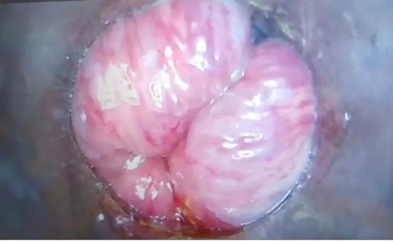 Revolutionizing Piles Treatment: The Advantages of Video Proctoscopy — hero image, Sharvari Hospital blog