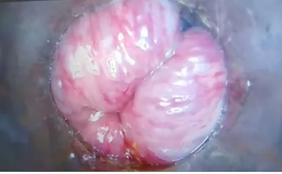 Revolutionizing Piles Treatment: The Advantages of Video Proctoscopy - Sharvari Hospital Blog