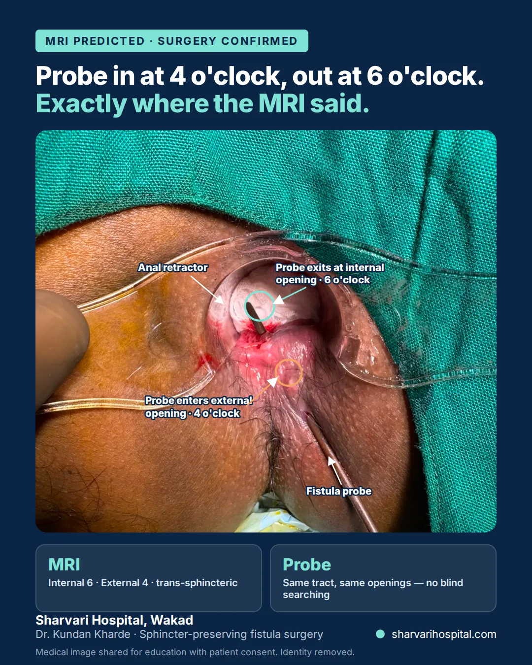 Intra-operative photo: fistula probe entering the external opening at 4 o'clock and exiting at the internal opening at 6 o'clock, matching the MRI map
