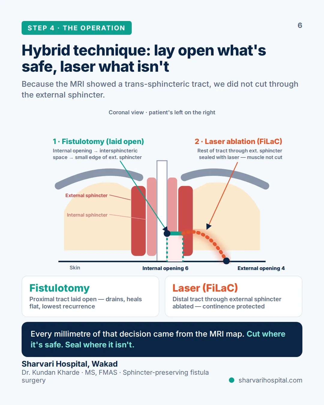 Diagram of hybrid fistula surgery: fistulotomy of the proximal tract through the intersphincteric space, FiLaC laser ablation of the part inside the external sphincter