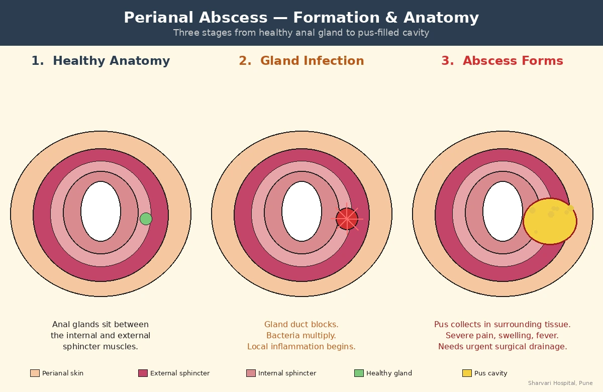 Perianal abscess anatomy diagram showing anal gland infection, pus cavity in perianal tissue, and potential fistula tract formation