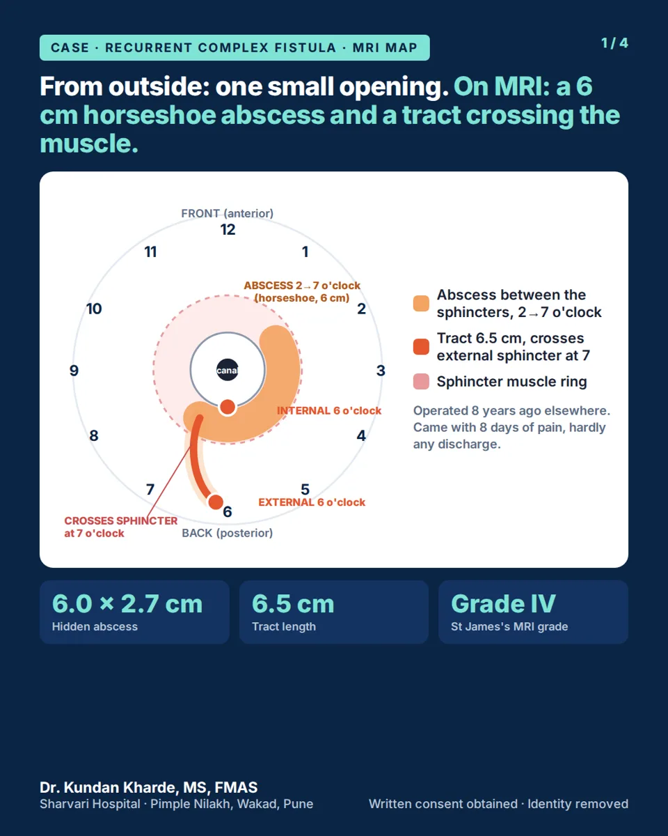 Fistula Came Back After Surgery? Why Little Discharge Can Hide a Large Abscess (With a Real MRI-Mapped Case) — featured image, Sharvari Hospital blog