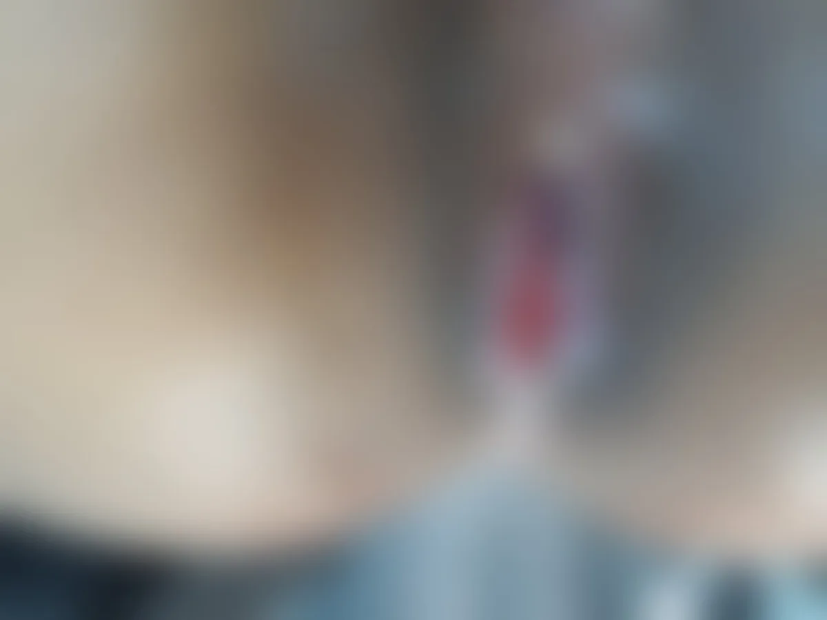 Anal Stenosis After Piles Surgery: Why the Anal Canal Narrows, Why Creams Stop Working, and How It Is Corrected (With a Real Case) — featured image, Sharvari Hospital blog